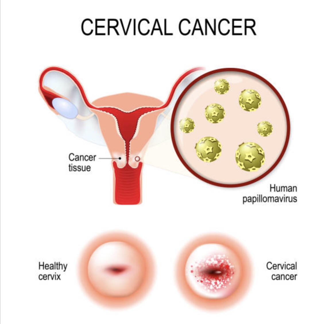 Ministry of Public Health | Cervical Cancer Screening Campaign